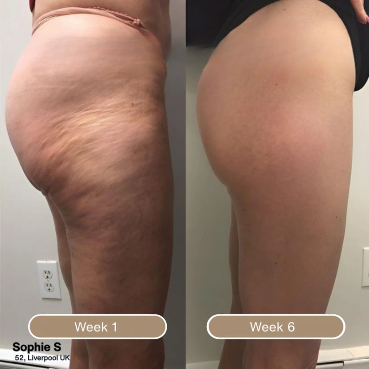 Korrazo Anti Cellulite Massage Oil